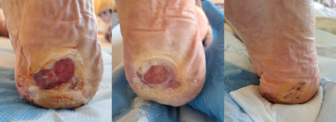 2-yr-old diabetic foot wound case study